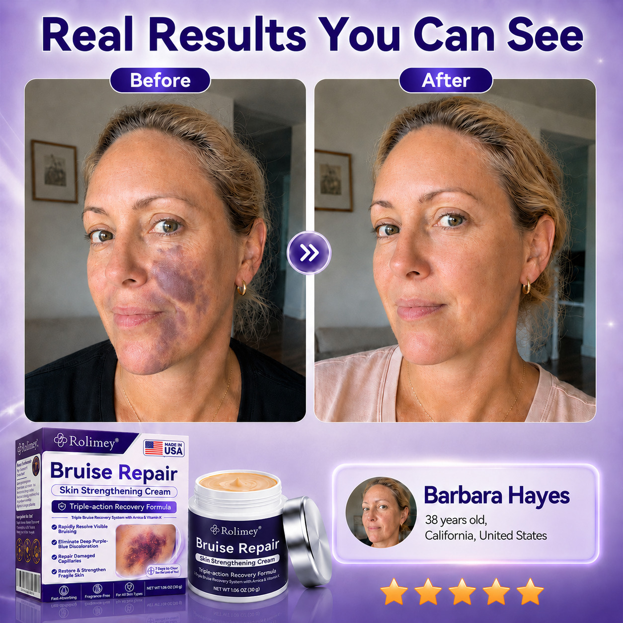 👨‍⚕️Over 100,000 units sold💕 - Rolimey® cream to repair bruises and strengthen the skin.
