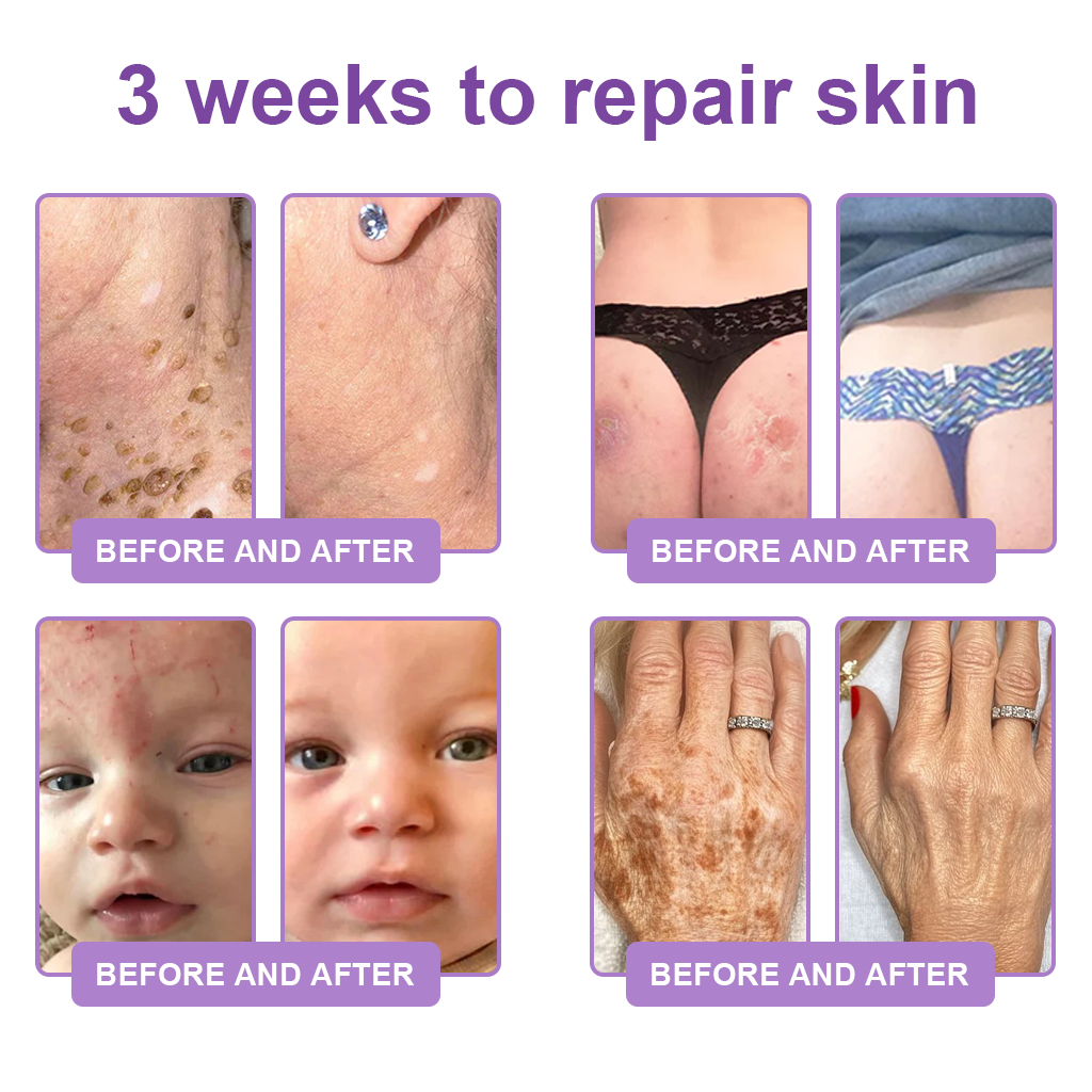 💜ROLIMEY® 𝐏𝐃𝐑𝐍 𝐌𝐮𝐥𝐭𝐢-𝐏𝐞𝐩𝐭𝐢𝐝𝐞 𝐌𝐚𝐬𝐬𝐚𝐠𝐢𝐧𝐠 𝐁𝐨𝐝𝐲 𝐑𝐨𝐥𝐥𝐞𝐫 𝐂𝐫𝐞𝐚𝐦- 𝐀𝐧𝐭𝐢-𝐚𝐠𝐢𝐧𝐠, 𝐇𝐲𝐝𝐫𝐚𝐭𝐢𝐧𝐠, 𝐒𝐤𝐢𝐧 𝐅𝐢𝐫𝐦𝐢𝐧𝐠 & 𝐋𝐢𝐟𝐭𝐢𝐧𝐠, 𝐒𝐤𝐢𝐧 𝐑𝐞𝐩𝐚𝐢𝐫, 𝐄𝐯𝐞𝐧 𝐓𝐨𝐧𝐞, 𝐀𝐜𝐧𝐞 𝐚𝐧𝐝 𝐃𝐚𝐫𝐤 𝐒𝐩𝐨𝐭 𝐓𝐫𝐞𝐚𝐭𝐦𝐞𝐧𝐭, 𝐖𝐚𝐫𝐭 𝐚𝐧𝐝 𝐌𝐨𝐥𝐞 𝐑𝐞𝐦𝐨𝐯𝐚𝐥, 𝐚𝐧𝐝 𝐏𝐬𝐨𝐫𝐢𝐚𝐬𝐢𝐬 𝐑𝐞𝐥𝐢𝐞𝐟.